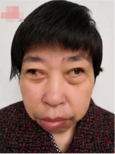 走失者照片 南通市寻亲：七旬老太被救助，双眼斜...