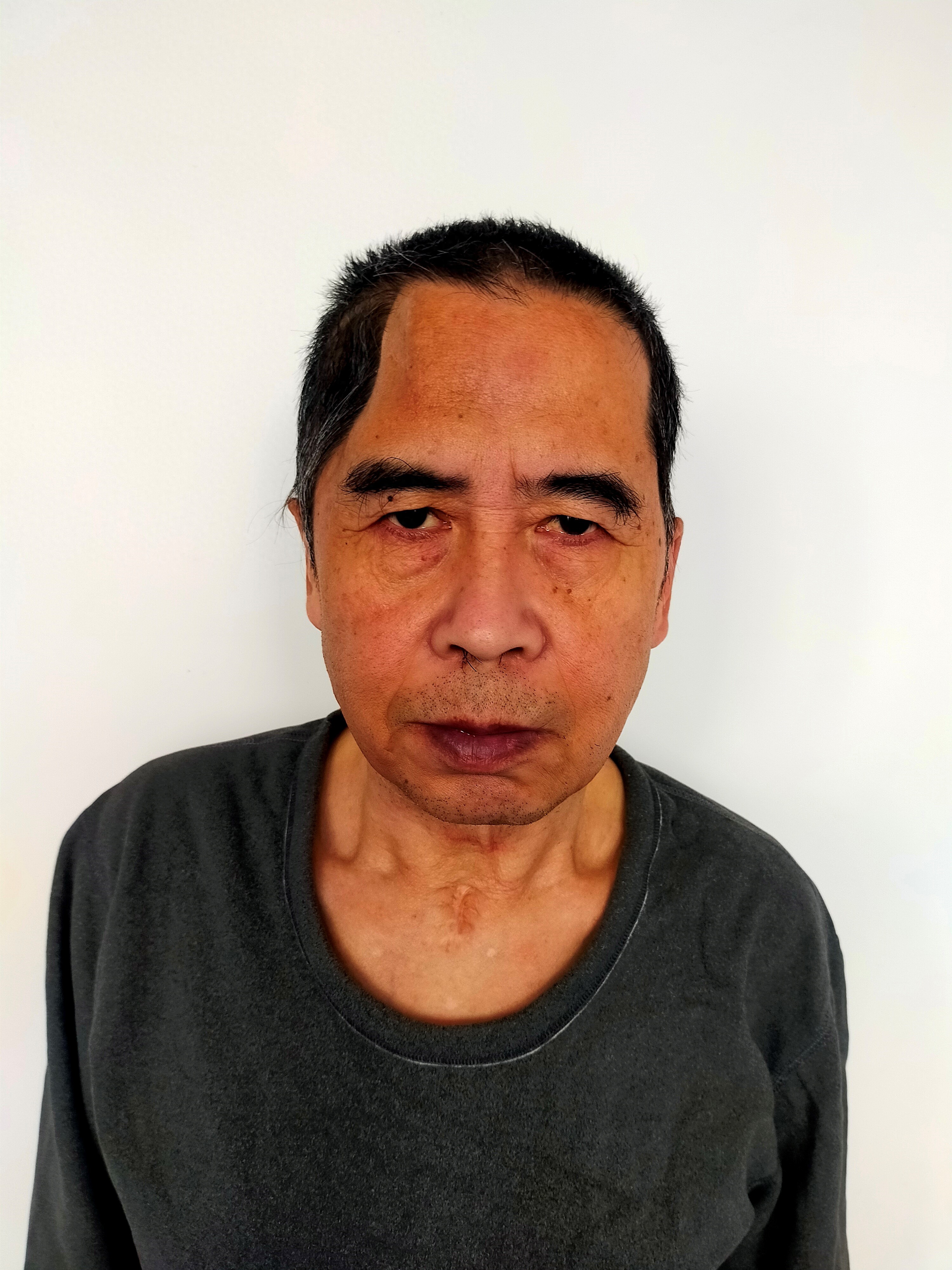 走失者照片 北京市寻亲：中年男子被救助，右侧头...