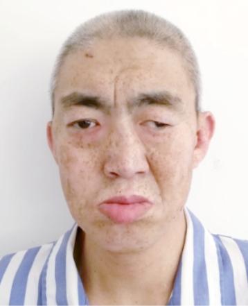 走失者照片 北京市寻亲：中年男子被救助，一只眼...