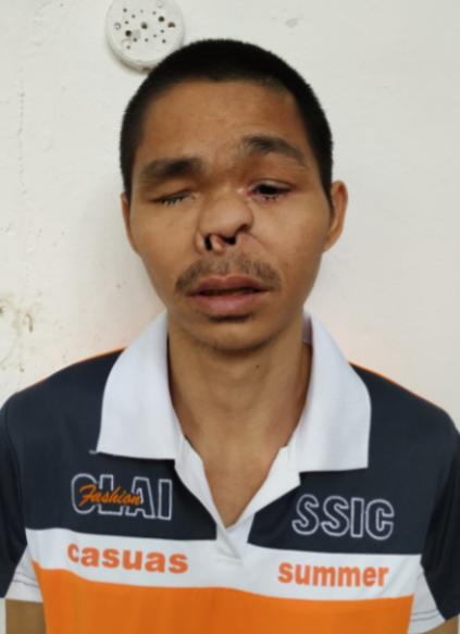 走失者照片 潮州市寻亲：中年男子被救助，右眼缺...