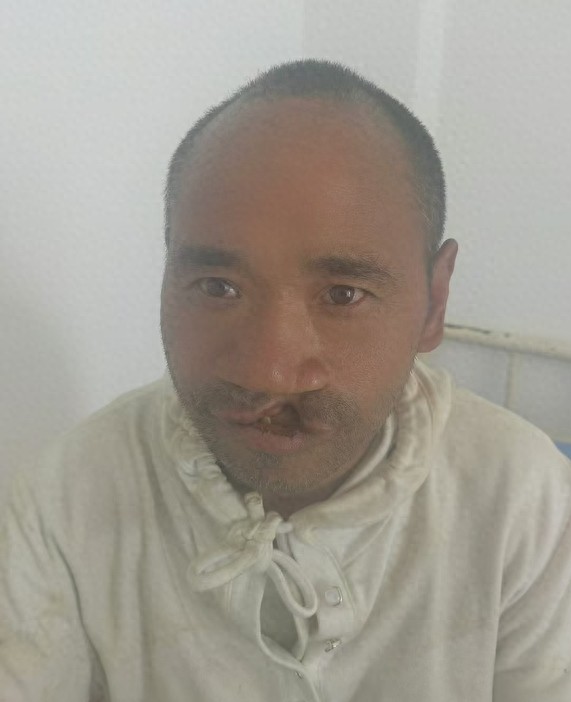 走失者照片 曲靖市寻亲：中年男子被救助，患唇腭...