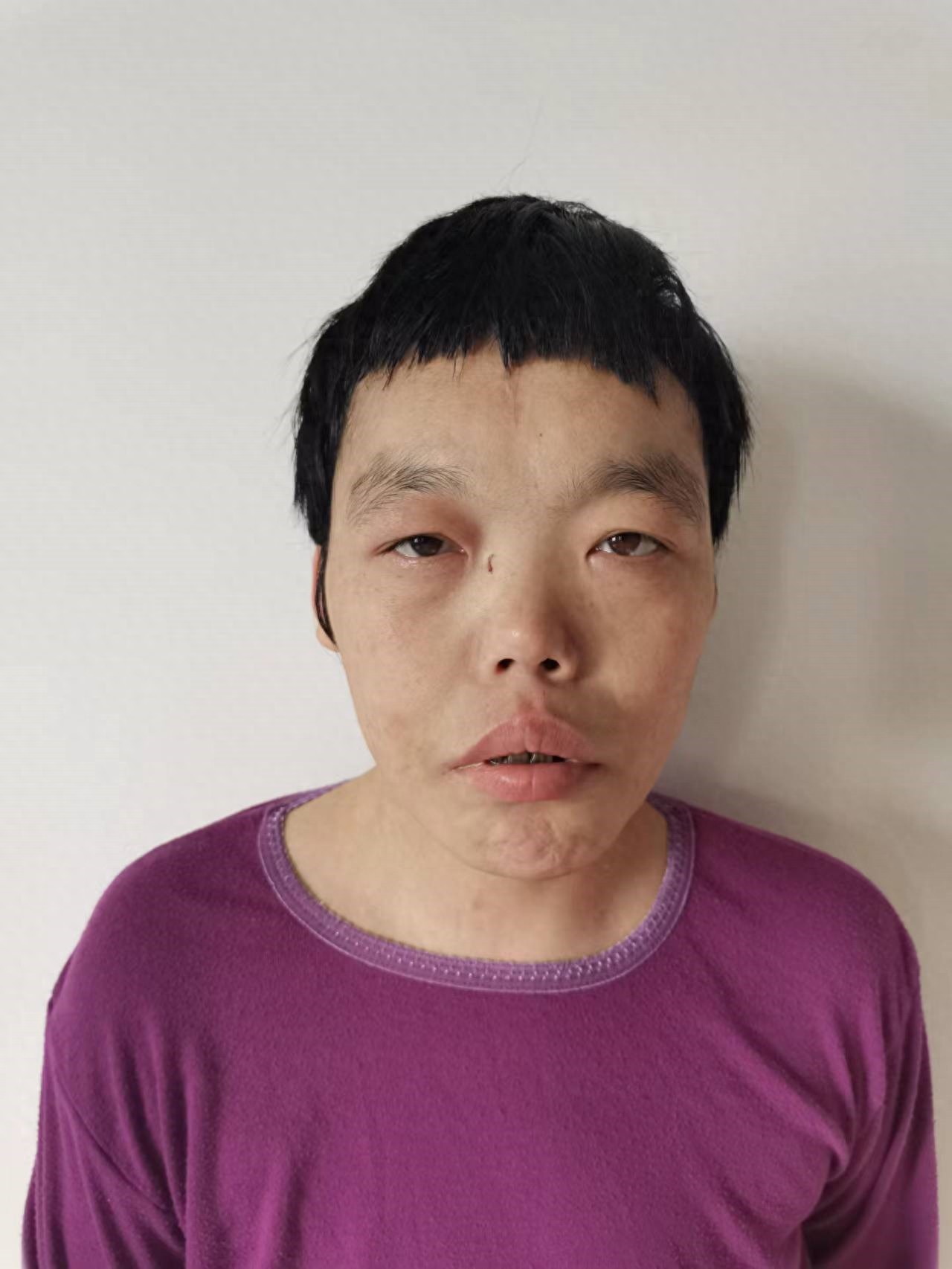 走失者照片 北京市寻亲：青年女子被救助，牙齿缺...