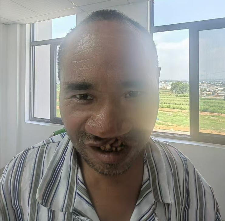 走失者照片 曲靖市寻亲：中年男子被救助，患唇腭...