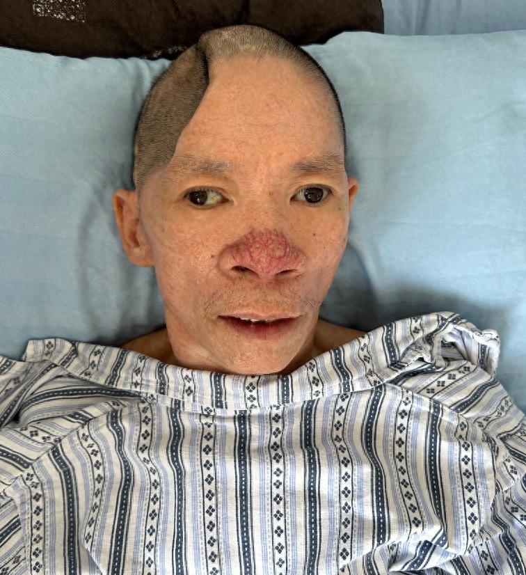 走失者照片 普洱市寻亲：五旬男子被救助，头颅凹...