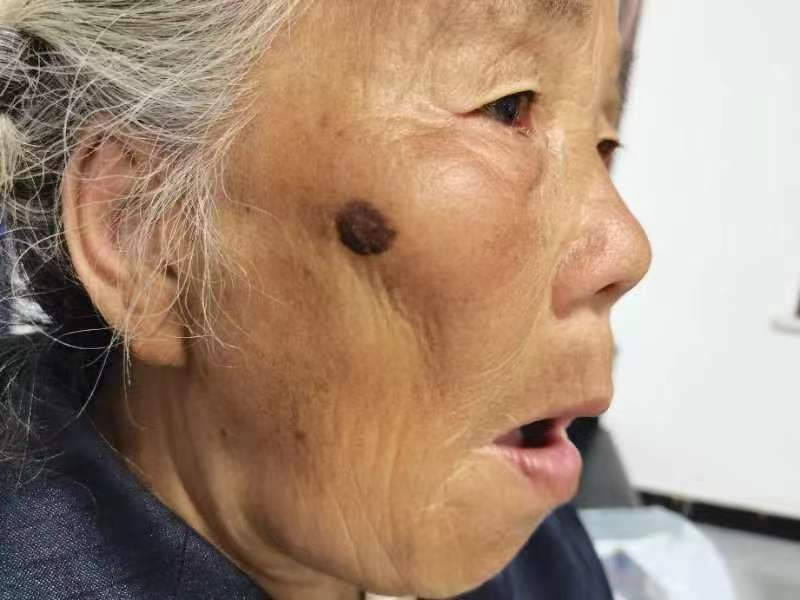 走失者照片 德州市寻亲：七旬老太被救助，右侧脸...