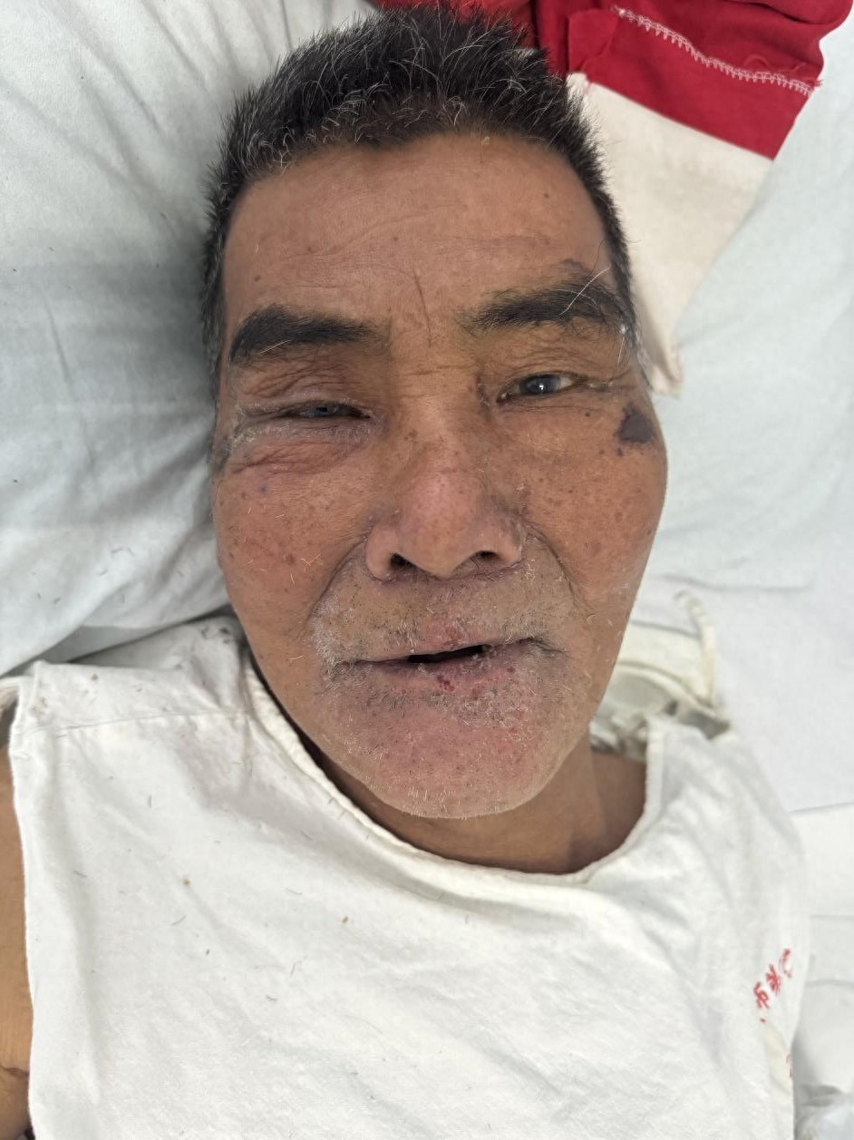 走失者照片 惠州市寻亲：七旬老人因左上肢感染被...