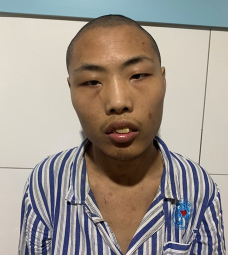 走失者照片 济南市寻亲：青年男子被救助，右眼下...