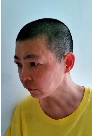 走失者照片 厦门寻亲：青年女子被救助，右脸颊处...