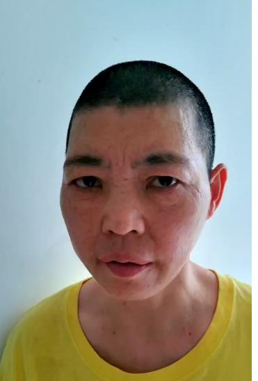 走失者照片 厦门寻亲：青年女子被救助，右脸颊处...