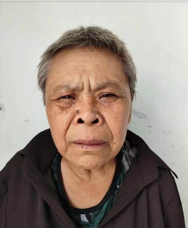 走失者照片 宜春寻亲：六旬老太被救助，鼻梁右侧...