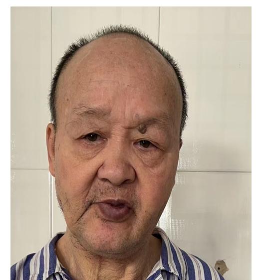 走失者照片 福州福清寻亲：六旬老人被救助，左眉...