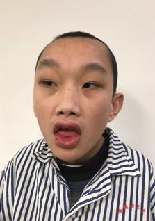 走失者照片 嘉兴平湖寻亲：18岁少年被救助，嘴...
