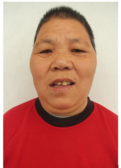 走失者照片 临沂寻亲：中年男子被救助，高1米5...