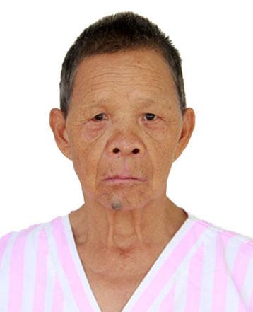 走失者照片 北海寻亲：七旬老太被救助多年，下巴...
