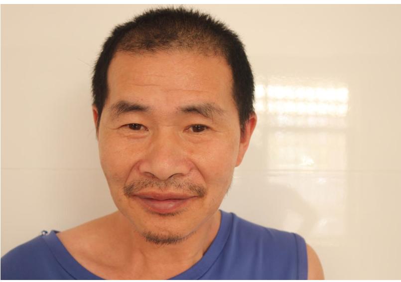 走失者照片 衢州寻亲：五旬男子被救助，头部有疤...