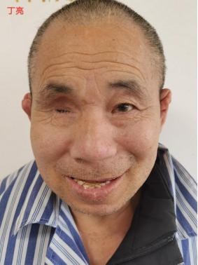 走失者照片 赣州寻亲：中年男子被救助，右眼失明...